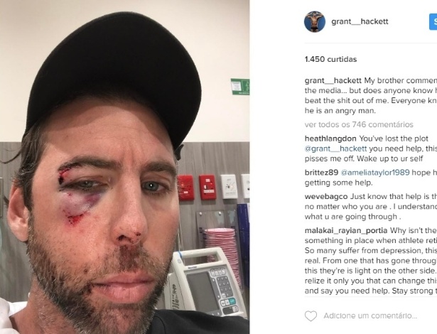 Grant Hackett aparece com o rosto machucado após ser preso  - Reprodução/Instagram