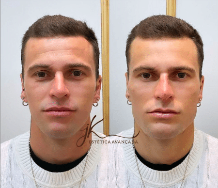 Lucas Lima Shows The Result Of Facial Harmonization Look