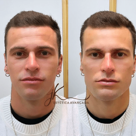 Lucas Lima faz harmonização facial e aplicação de botox no rosto - Instagram