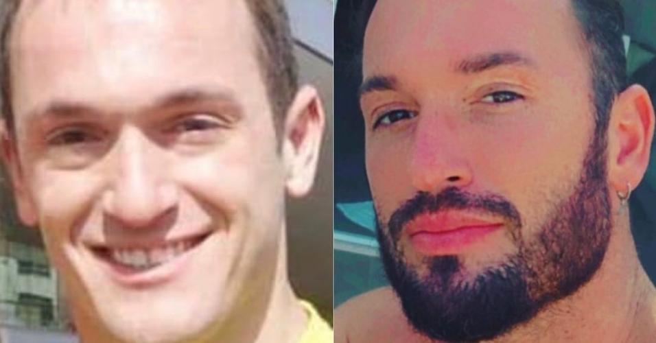 Diego Hypolito mostra antes e depois de procedimentos estéticos 