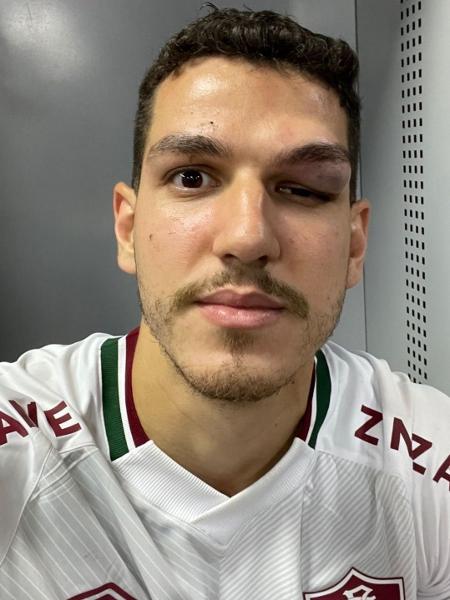 Nino postou foto de "galo" na cabeça após choque na vitória do Fluminense sobre o Athletico - Reprodução