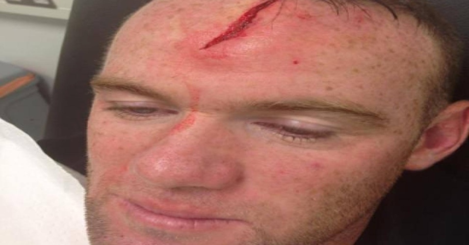 Rooney mostra grave lesão na cabeça