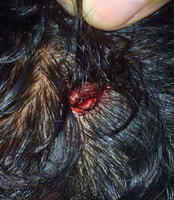 07.dez.2013 - Nenê mostra ferimento na cabeça depois de levar uma garrafada no vestiário do Al-Gharafa - Divulgação