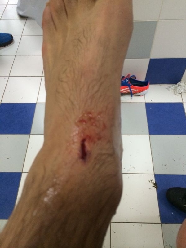 07.dez.2013 - Nenê mostra ferimento no pés esquerdo depois de receber entrada dura no Qatar - Divulgação