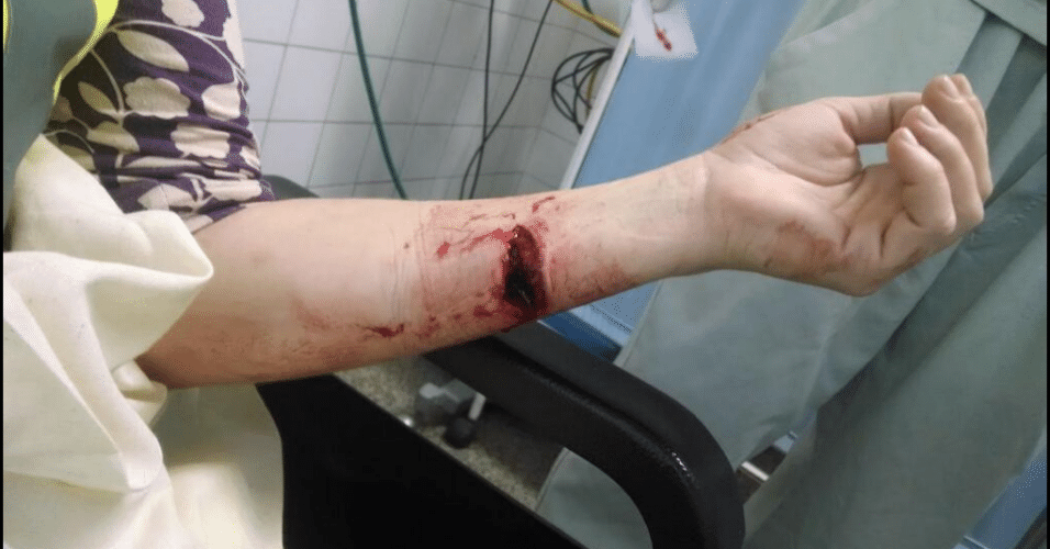 Detalhe do braço machucado da jornalista da CNN que se feriu durante protesto em São Paulo que terminou em confronto entre polícia e manifestantes