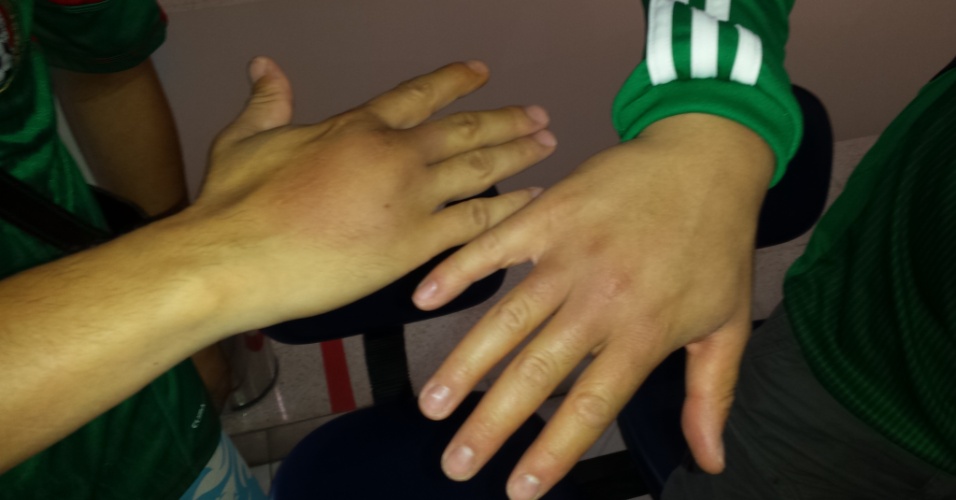 Mexicanos exibem hematomas na mão após briga com bandido em pousada em Natal