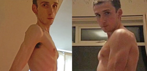 Danny Walsh chegou aos 38 kg em 2012 (à esq) antes de ser hospitalizado - Daily Star/Reprodução