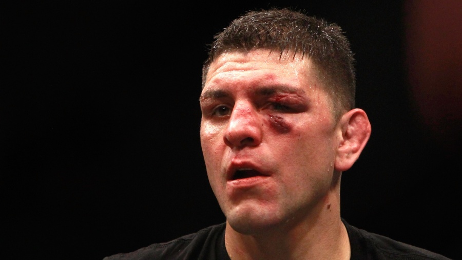 Nick Diaz após a luta que terminou sem vencedor com Anderson Silva - Steve Marcus/Getty Images/AFP