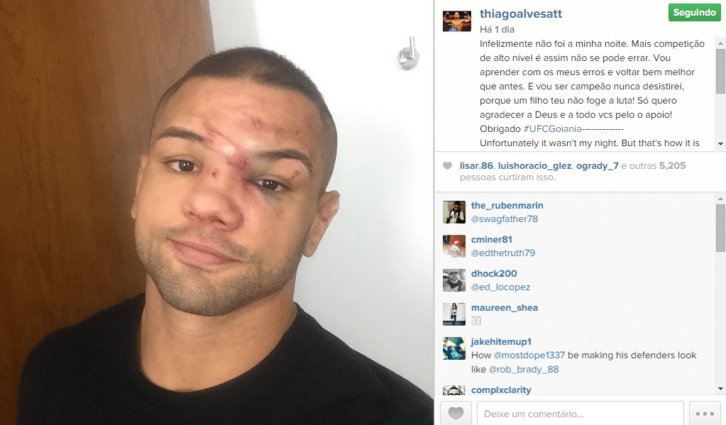 Thiago Alves ficou com o rosto deformado após uma cotovelada de Carlos Condit fraturar seu nariz na luta principal do UFC de Goiânia - Reprodução/Instagram