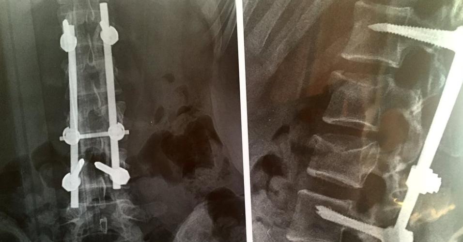 Médicos temiam que Maria não caminhaasse novamente