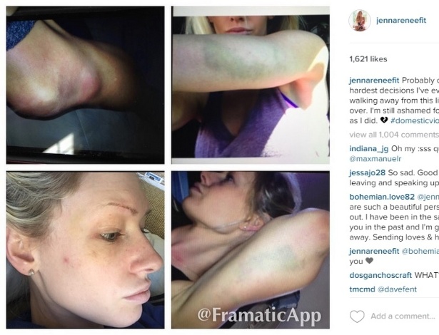 Renee Webb mostra lesões em rede social e acusa Travis Browne  - Reprodução/Twitter