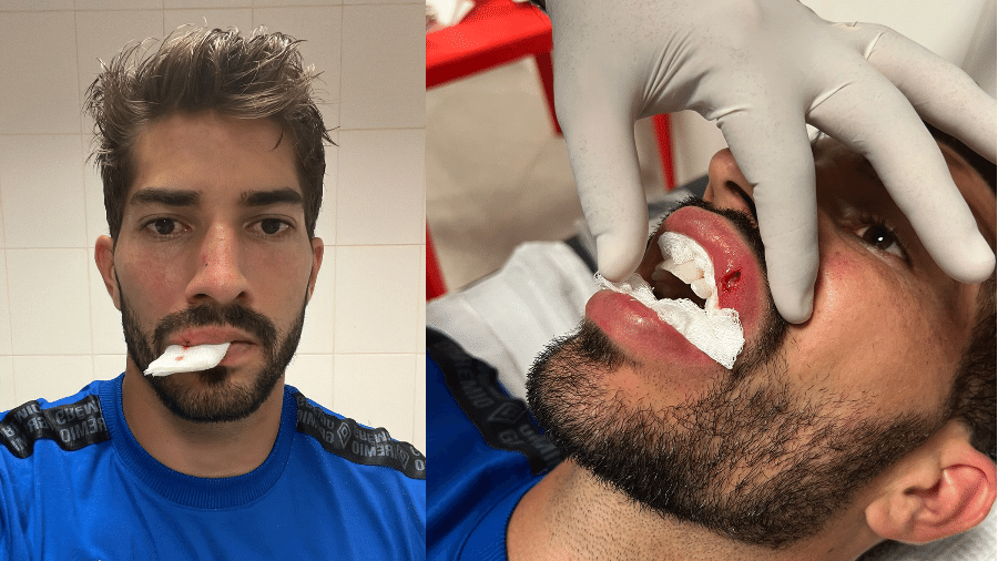 Lucas Silva, do Grêmio, mostra como ficou seus lábios após ser atingido por celular - Reprodução/Twitter