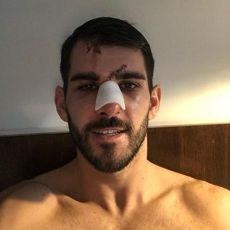 Nelson Oliveira foi submetido a uma cirurgia para reparar quatro fraturas no nariz - Instagram/noliveira9