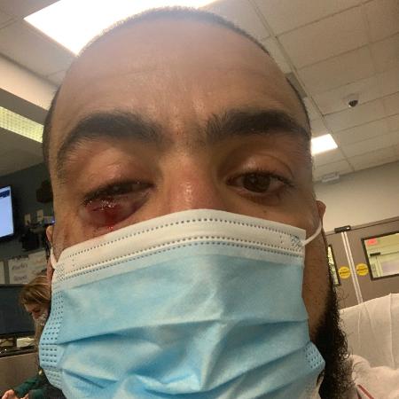 Olho de Belal Muhammad após incidente em luta do UFC - Reprodução/Twitter