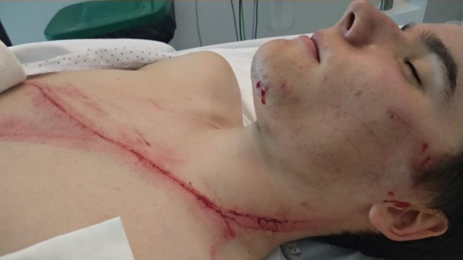 Ciclista Andoni Azkarate ficou com grande cicatriz após choque com guard-rail - Reprodução
