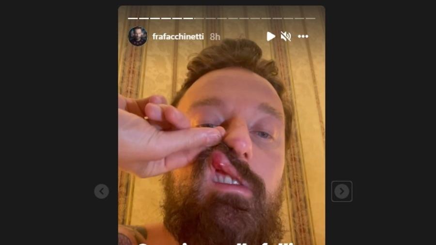 Cantor italiano Francesco Facchinetti mostra ferimento no lábio - Reprodução/Instagram