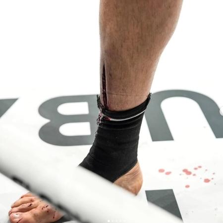 Corte na canela de Jamal Ben Saddik em combate no Glory 100. Corte na canela de Jamal Ben Saddik em combate no Glory 100.