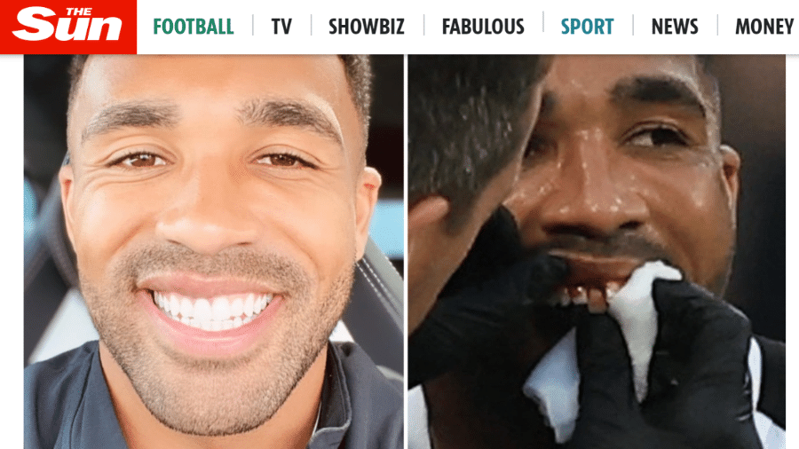 Atacante do Newcastle, Callum Wilson, mostra seu sorriso renovado após dente ficar pendurado durante jogo - Reprodução/The Sun