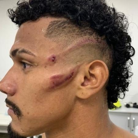 Fernando Sobral recebeu chute no rosto de Juninho, do Fortaleza, no clássico cearense - Reprodução/Instagram