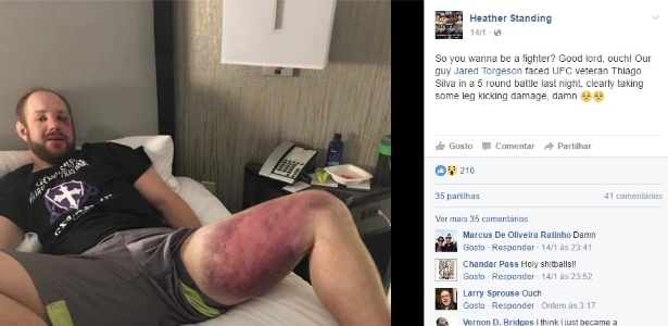 Jared Torgeson mostra hematomas depois de ter lutado contra o brasileiro Thiago Silva - Reprodução / Facebook
