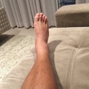 Inchado um tornozelo como é