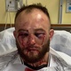 Lutador mostra rosto desfigurado após derrota para brasileiro no UFC; veja