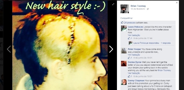 Brian Toomey brinca com seu visual após a cirurgia a que foi submetido - Reprodução/Facebook