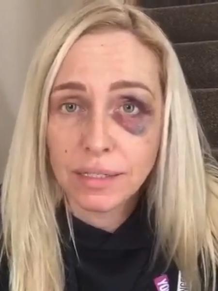 Josie Gibson aparece de olho roxo ao denunciar agressão de Tommy Jenkins - Reprodução/Instagram