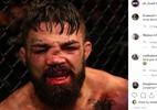 Americano fica com nariz desfigurado em derrota para brasileiro no UFC - Reprodução