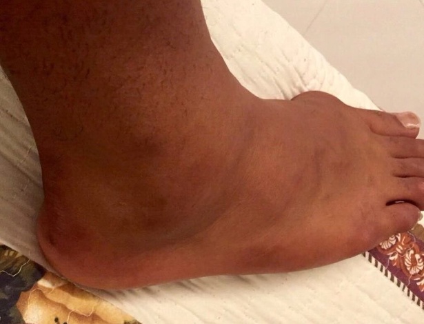 Artilheiro do Bahia na temporada, Kieza postou foto do pé inchado nas redes sociais - Reprodução/Facebook