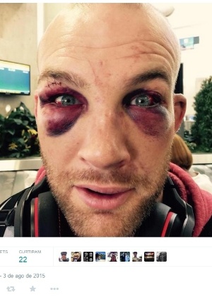 Patrick Cummins ficou com os olhos bem machucados após confronto com Rafael Feijão - Reprodução/Twitter