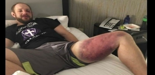 Torgerson ficou com a perna machucada após duelo com Thiago Silva - Reprodução/Facebook