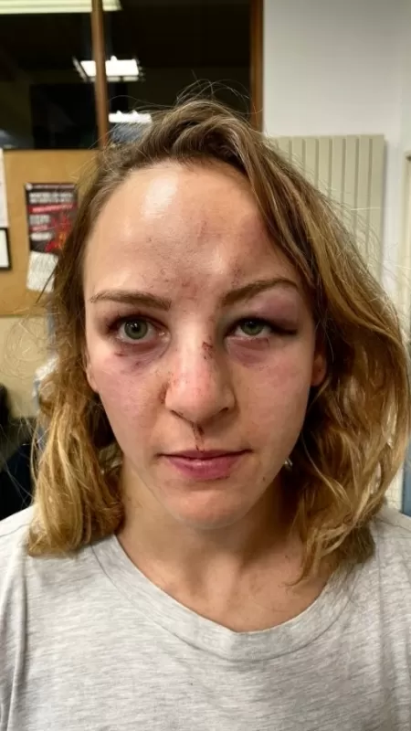 MidiaNews | Campeã olímpica fica desfigurada após agressão do marido