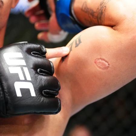 André Mascote mostra a marca da mordida de Igor Severino no UFC