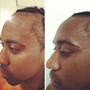 Arouca posta foto mostrando corte no supercílio sofrido na partida entre Fluminense e Palmeiras pelo Campeonato Brasileiro - undefined