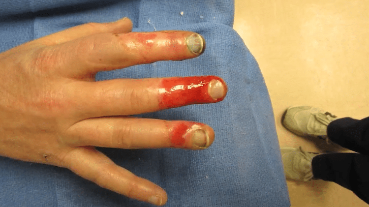 Torcedor teve queimadura nos dedos após jogo da NFL