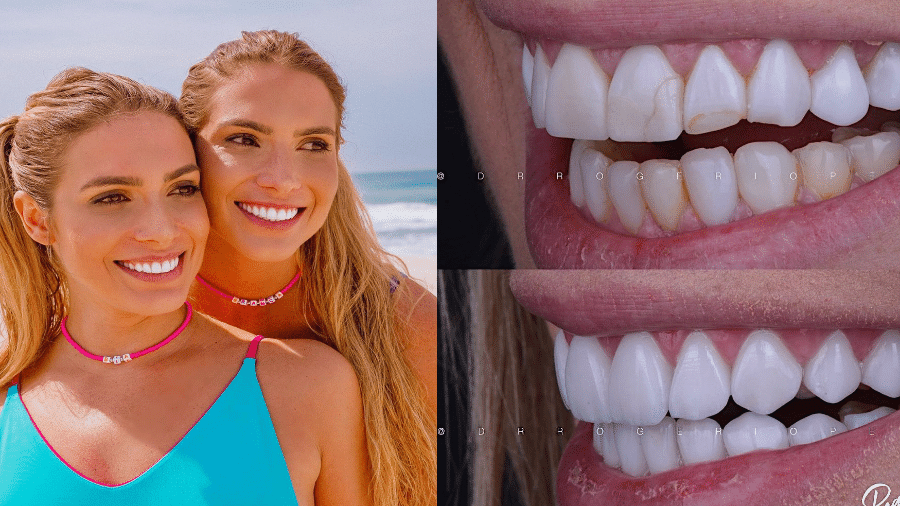 Gêmeas Bia e Branca Feres falam sobre problemas causados por lentes dentárias - Reprodução/Instagram/biaebrancaferes/drrogeriopenna