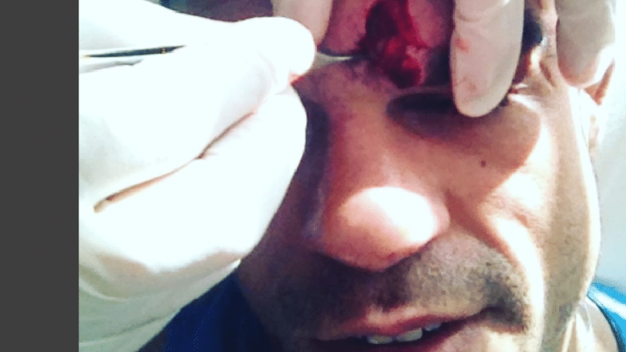 Vitor Belfort mostra corte profundo na testa durante treino - Reprodução/Instagram