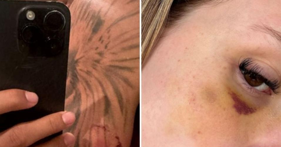 Caio Paulista mostra marca de mordida no braço; Clara Monteiro mostra lesão no rosto