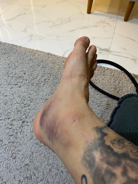 Zé Rafael postou a foto de seu tornozelo direito, após a vitória do Palmeiras - Reprodução