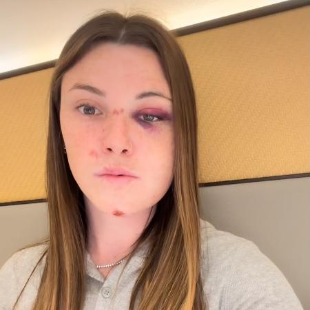 Eduarda Bordignon após sofrer acidente durante etapa da Copa do Mundo de Ciclismo BMX Eduarda Bordignon após sofrer acidente durante etapa da Copa do Mundo de Ciclismo BMX