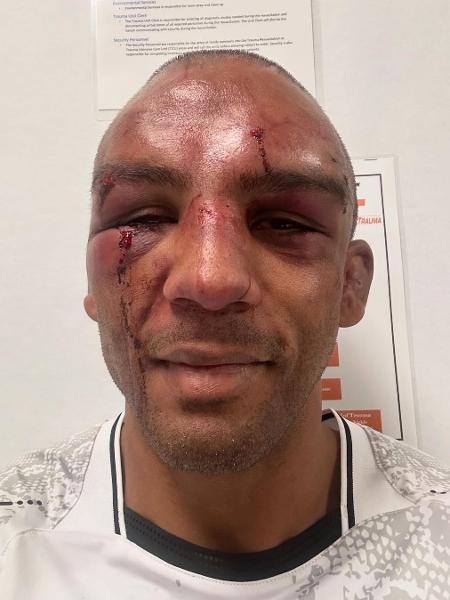 Edson Barboza expôs nas redes sociais os danos no rosto após sua última luta; após seis dias, estava recuperado