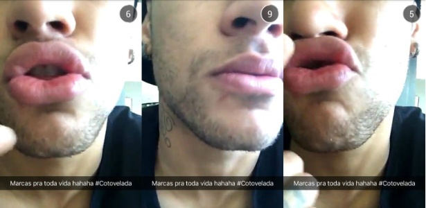 Neymar exibe marcas no rosto que seriam de cotoveladas recebidas no duelo contra o Rayo - Reprodução