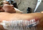 Lindsey Vonn mostra cicatriz no braço após queda em treinamento nos EUA - Reprodução/Instagram 