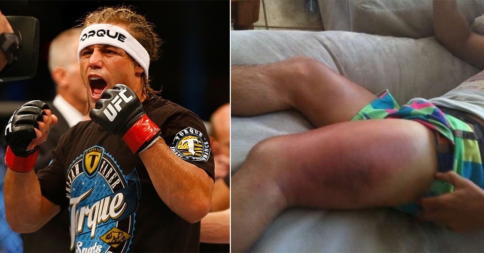 Lutadores não sofrem só no rosto. Urijah Faber, nos tempos de WEC, ficou com a perna assim por conta dos chutes de José Aldo - Getty Images e Reprodução/Instagram