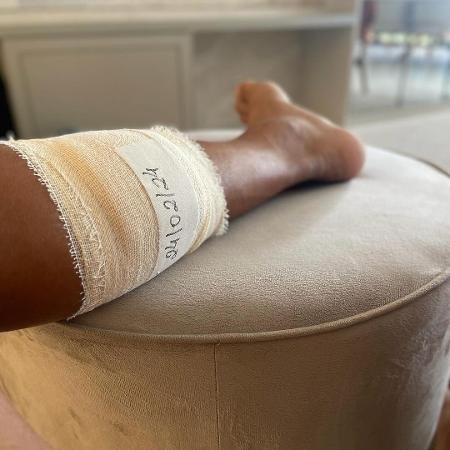 Detalhe da perna do zagueiro Titi, do Fortaleza, após procedimento para remoção dos estilhaços