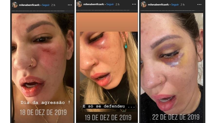 Milena Bemfica, ex-mulher Jean, publica novas fotos da briga com o goleiro - Reprodução/Instagram/milenabemficaofc