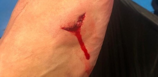 Maxi Lopez exibiu a lesão que pode tira-lo também do jogo com o Corinthians - Reprodução/Instagram