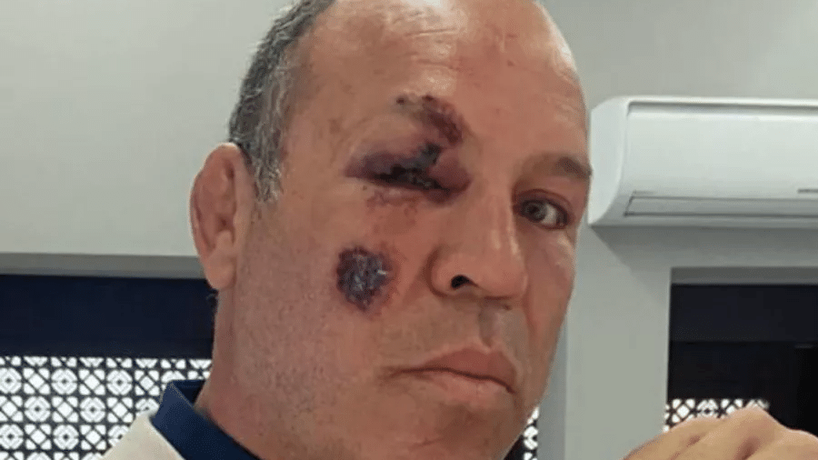 Wanderlei Silva compartilhou foto mostrando ferimentos no rosto após o atropelamento - Arquivo pessoal