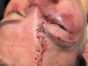 Imagem forte! Aldana assusta com corte profundo após luta no UFC; veja